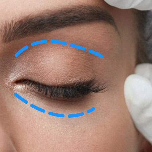 Augenlidkorrektur-Blepharoplastik