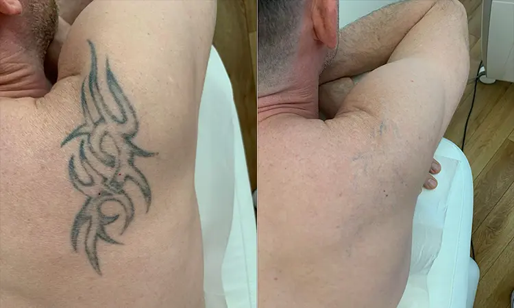 tattoo-entfernen-bonn